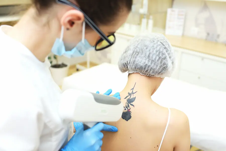 Rimozione laser del tattoo: come funziona il trattamento?